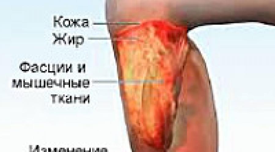 Некротизирующий фасциит причины. Молниеносный некротический фасциит после травяных компрессов