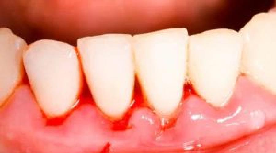 Методы лечения гнойного воспаления десны возле зуба. Что делать, если начал выделяться гной из десны около зуба Опухла десна и появился гной