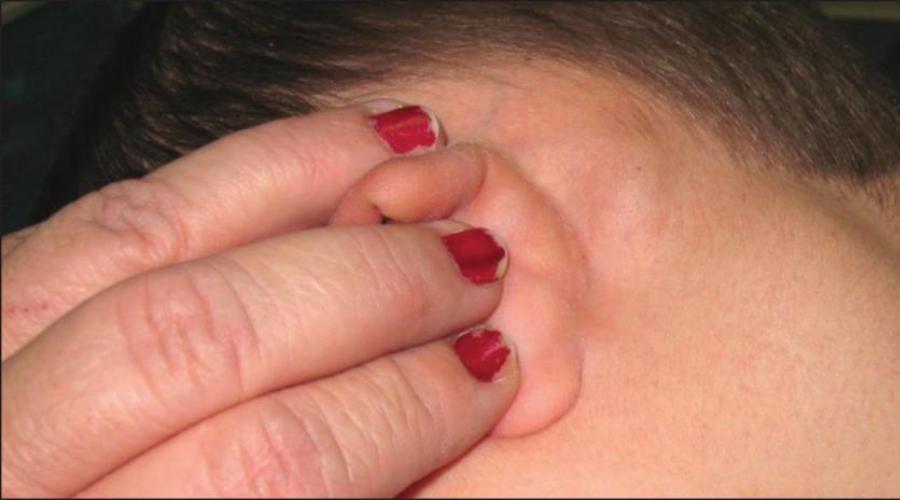 Постоянно воспаляются лимфоузлы на шее у ребенка. Почему опухают лимфоузлы только с одной стороны? Изменение размеров лимфоузлов у ребенка