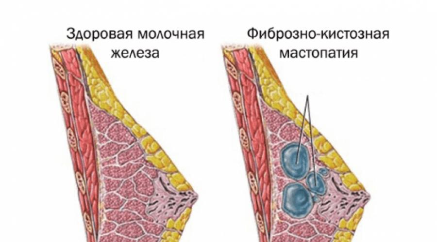 Болит молочная железа