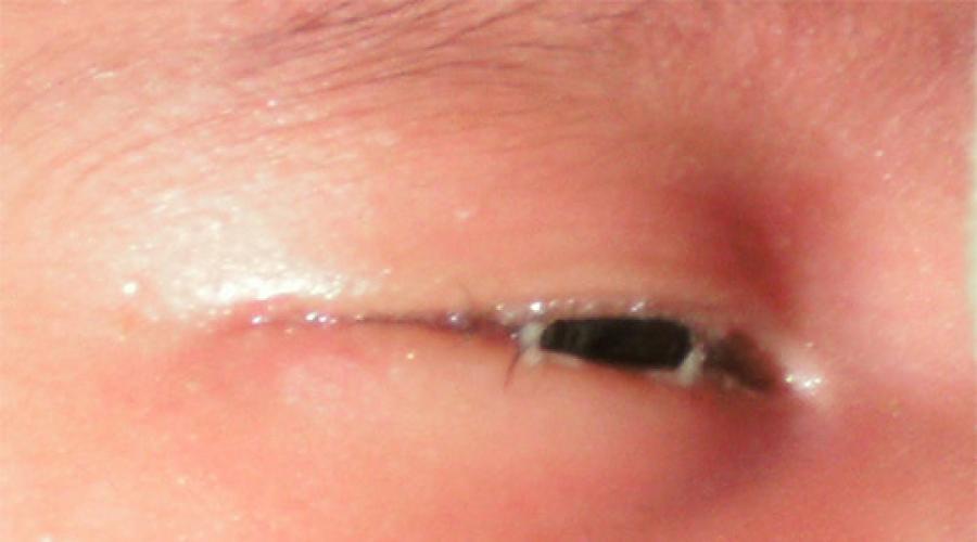 Глазные капли «Левомицетин» для детей. Левомицетин — капли глазные