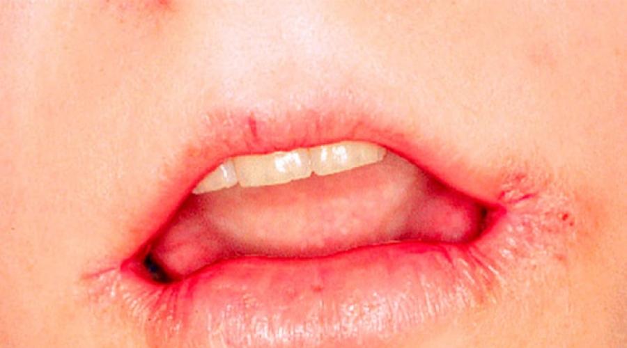 Заболевания губ — хейлит: симптомы и причины. Лечение хейлита у детей и взрослых