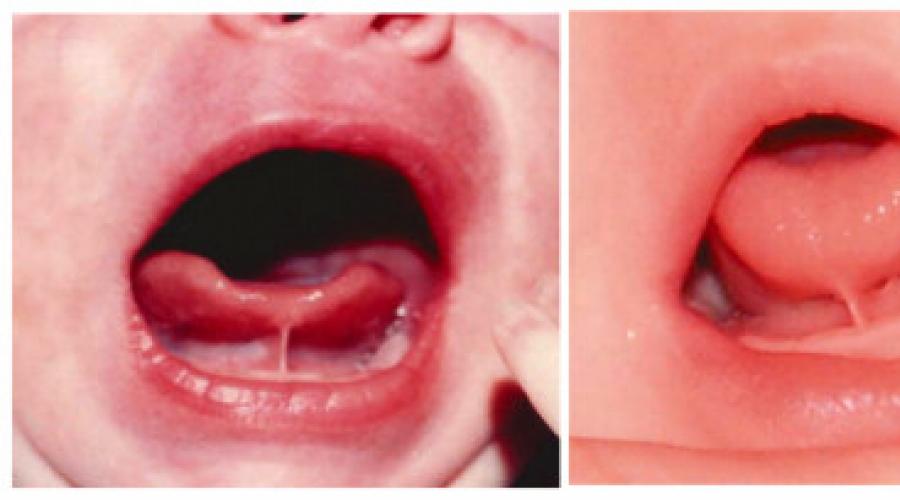 Почему под языком опухло и болит? Воспаление уздечки: лечение и симптомы. 