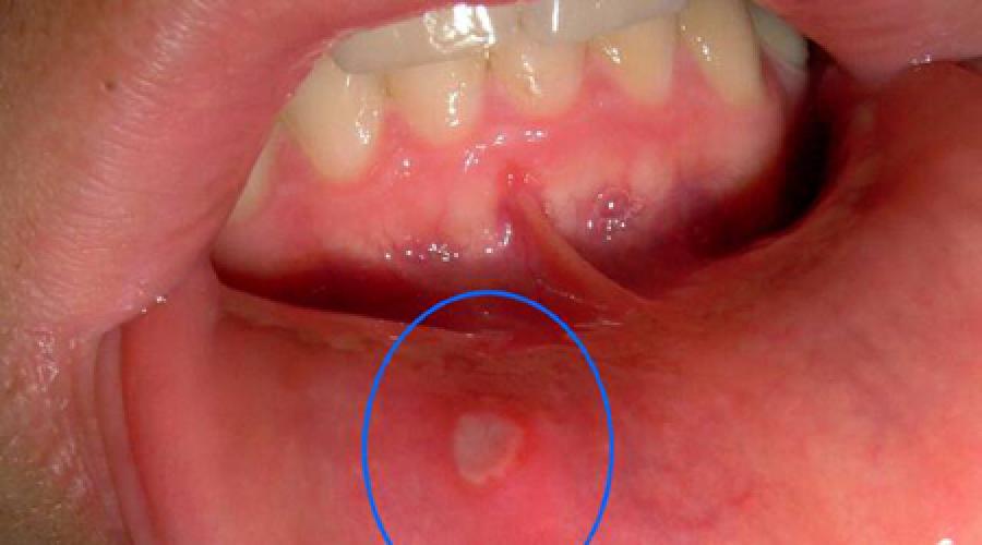 Белые язвы на деснах. Язвы во рту — фото, причины и лечение