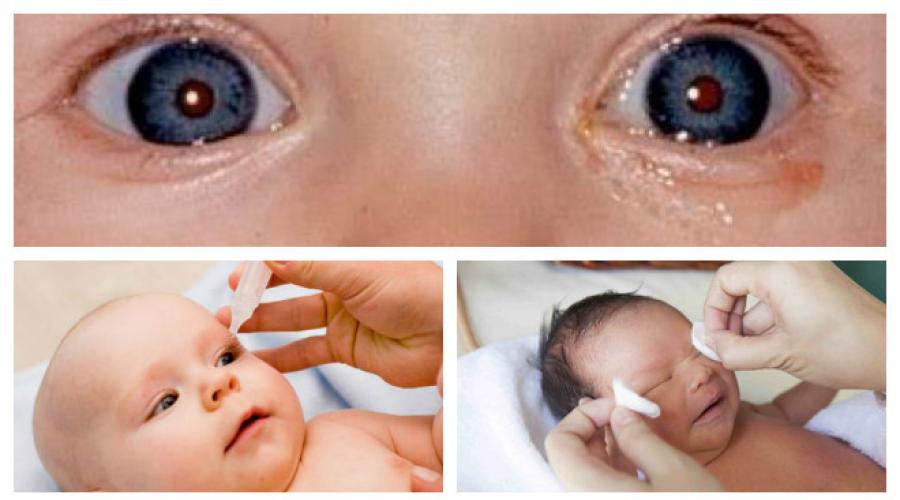Конъюнктивит у грудничков лечение. Как лечить бактериальный конъюнктивит у новорожденного? Лечение конъюнктивита глаз у младенцев