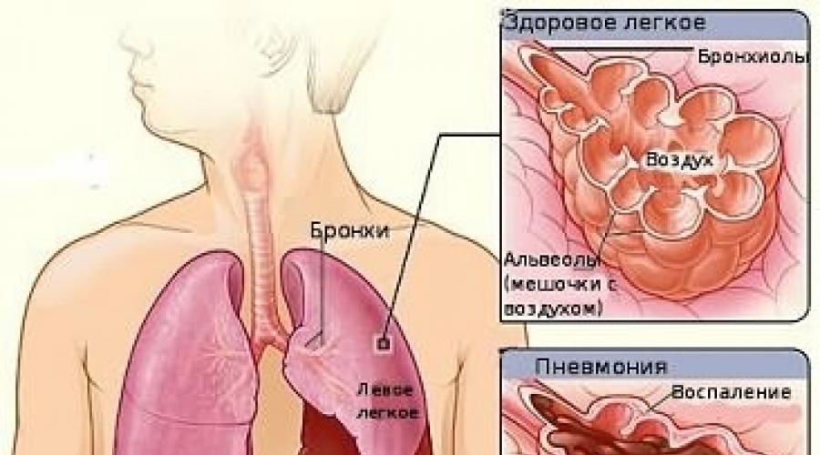 Привкус после кашля. Пневмония после ангины. Как распознать пневмонию у ребенка. Пневмония как распознать на ранней стадии.