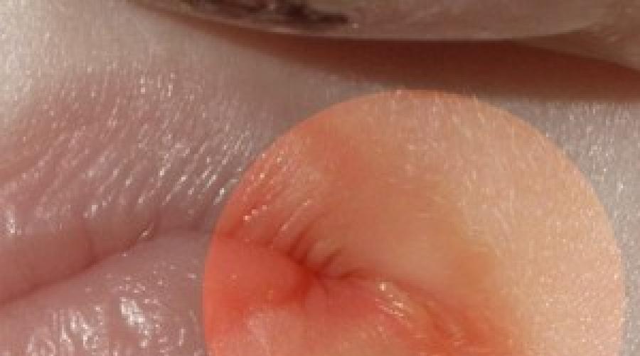 Что делать на губе вылезла болячка. Как лечить белую болячку на губе с внутренней стороны