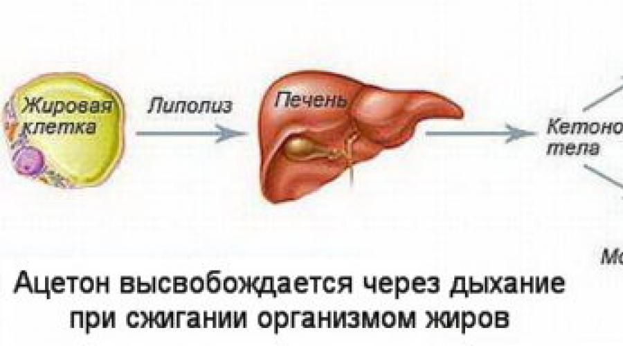 Токсикоз ацетон