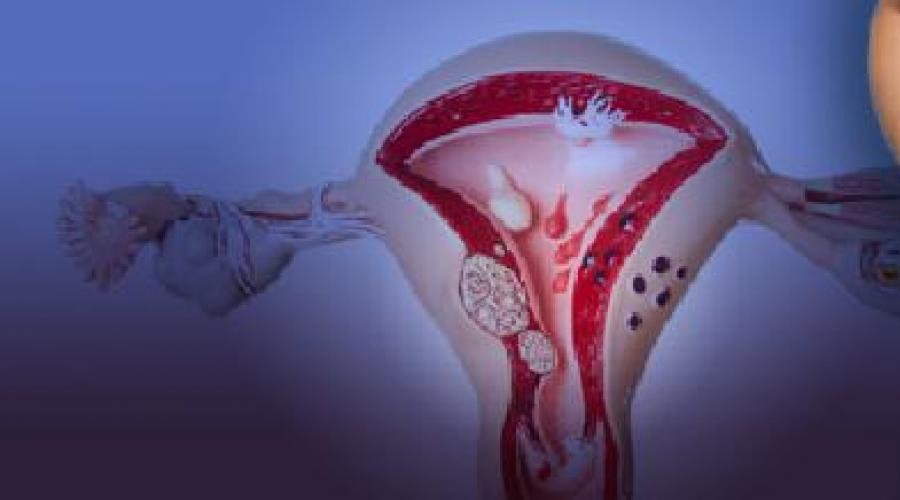 Опасные последствия невылеченного эндометриоза матки. Что такое эндометриоз и чем он опасен