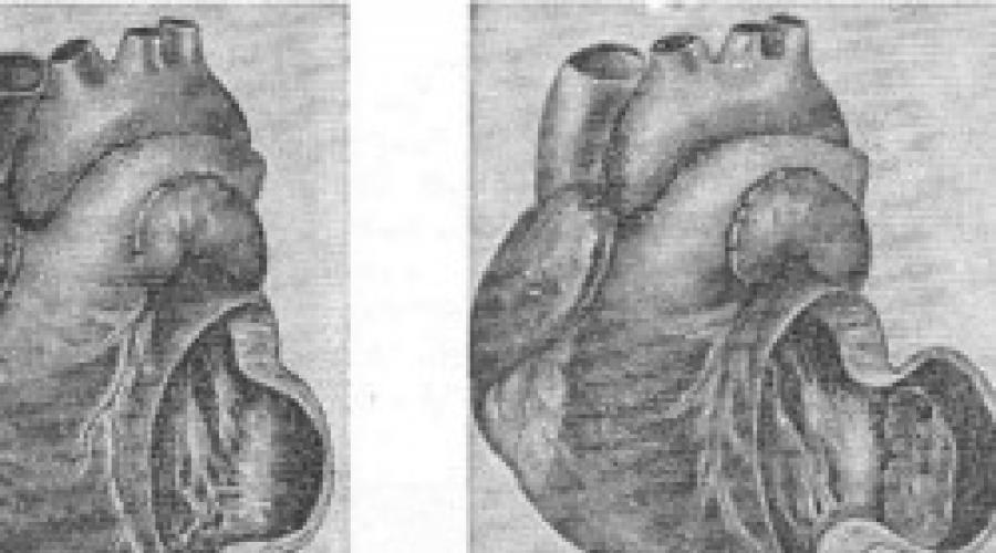 Острая и хроническая аневризма сердца: желудочка, перегородки, постинфарктная, врожденная. Аневризма Сердца – причины, симптомы, диагностика и лечение