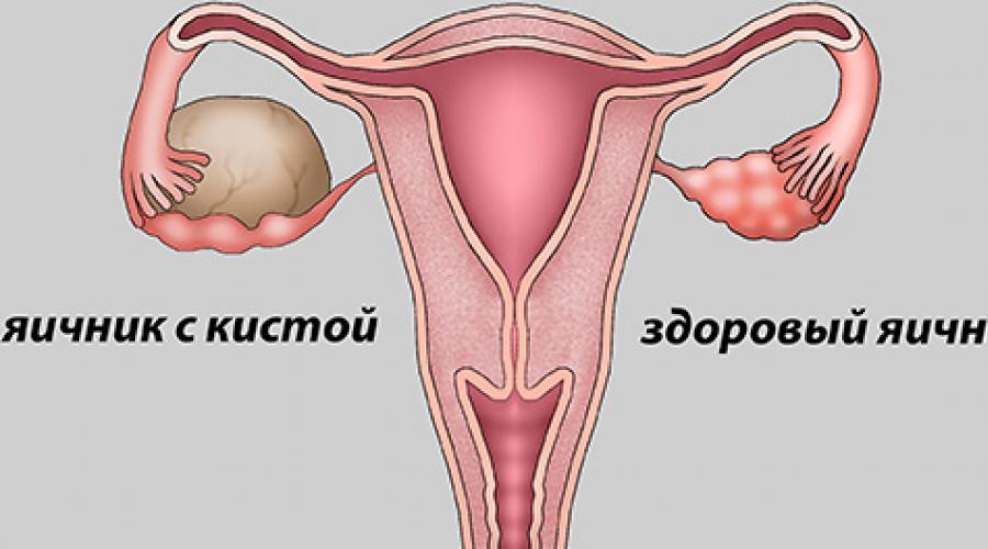 Ли киста яичника показывать беременность. Можно ли рожать с кистой яичника: возможные трудности