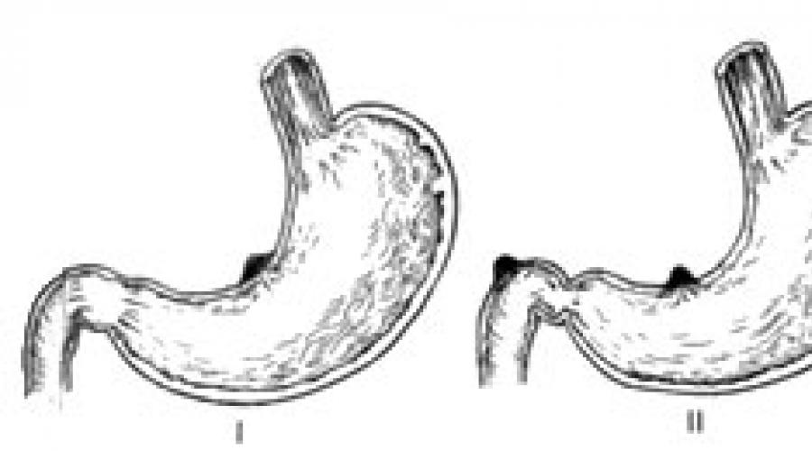 Мкб 10 язва 12 перстной кишки. Прободная язва желудка рентген. Прободение язвы 12 перстной кишки. Перфорация язвы желудка ФГДС. Перфорация язвы желудка рентген.