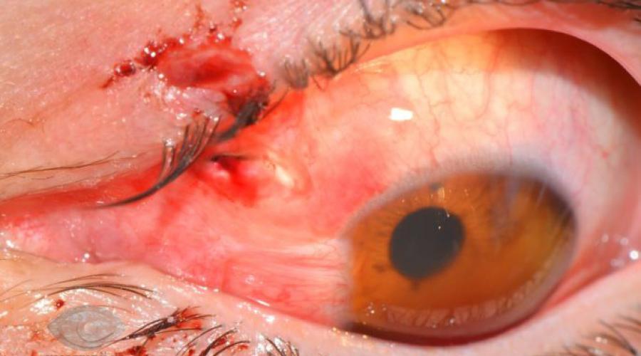 Ранения глаза. Повреждение глаз: причины и методы лечения