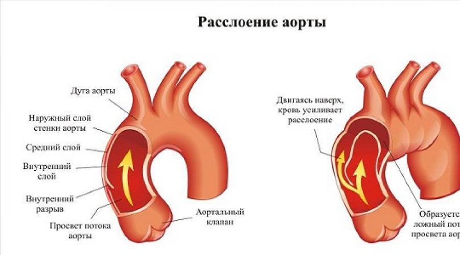 Уплотнение стенок аорты. Причины воспаления аорты. ЭКГ расслоение аорты особенность. Разрыв дуги аорты вызванный внешними причинами это. При отслоение аорты сердца пульс 33.