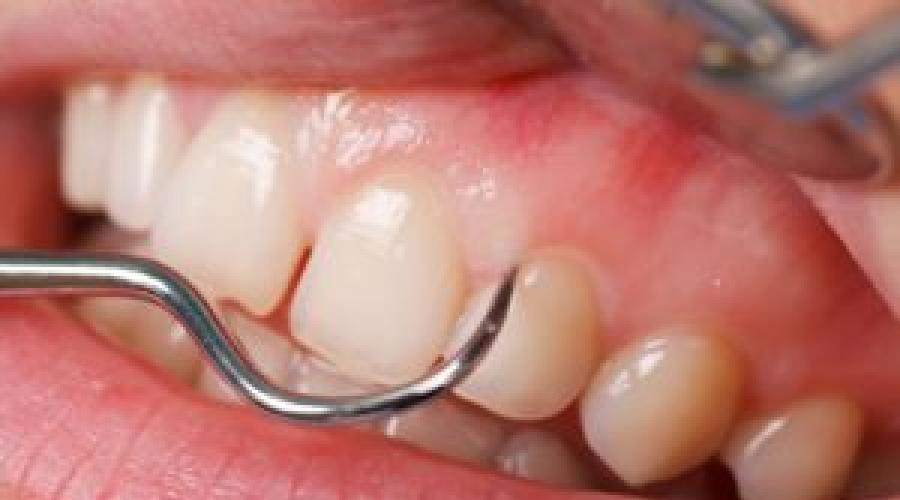 Воспаление десны около зуба: почему возникает проблема, откуда. Развитие воспаления под коронкой