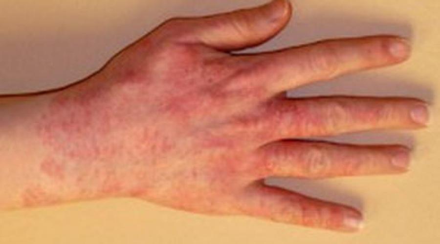При каких заболеваниях появляются красные пятна на коже? Почему на теле появляются розовые пятна и как от них избавиться. 