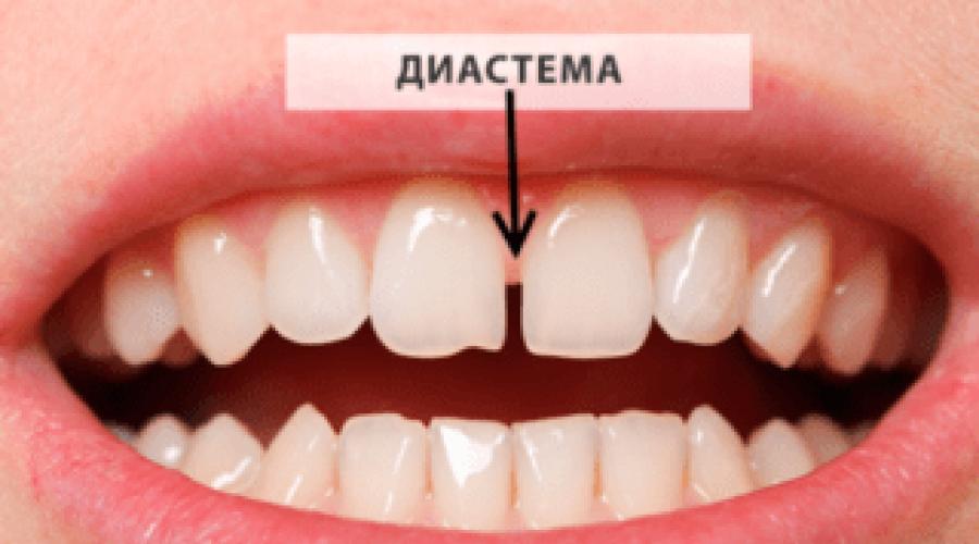 Расстояние между зубами. Почему появляется щель между передними зубами