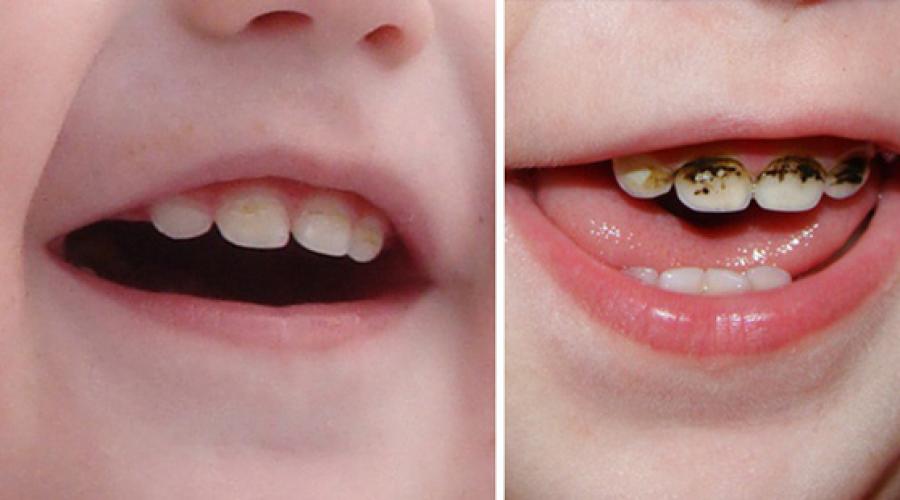 Серебрение зубов: кому показана процедура, как проходит. Посеребрение зубов у детей
