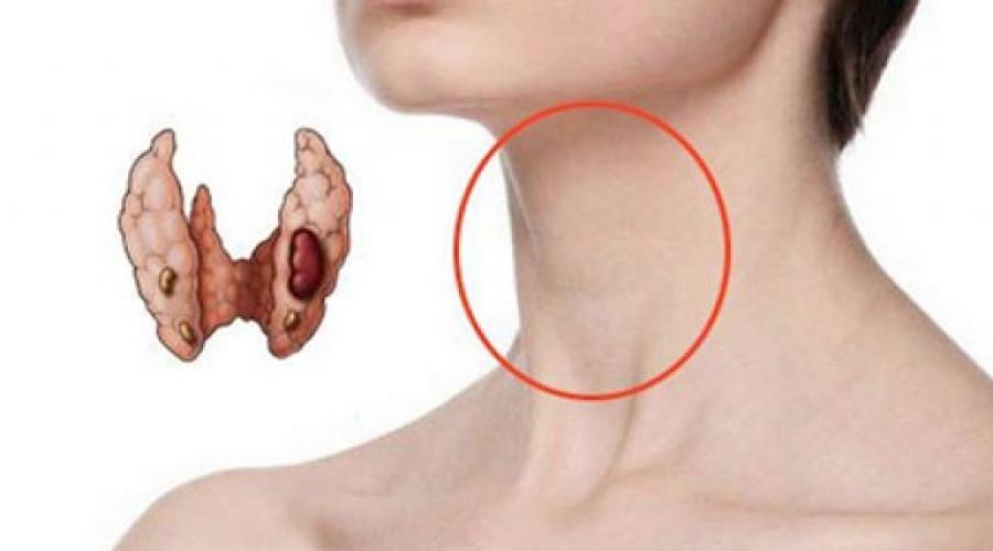Киста щитовидной железы симптомы. Узлы и кисты щитовидной железы: подробно от описания до причин и лечение образований