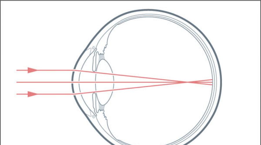Близорукость схема глаза