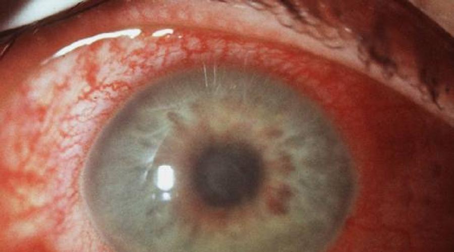 Почему появляются красные сосуды в глазах и как с этим бороться? Красные сосуды на белках глаз: методы лечения и профилактики. 