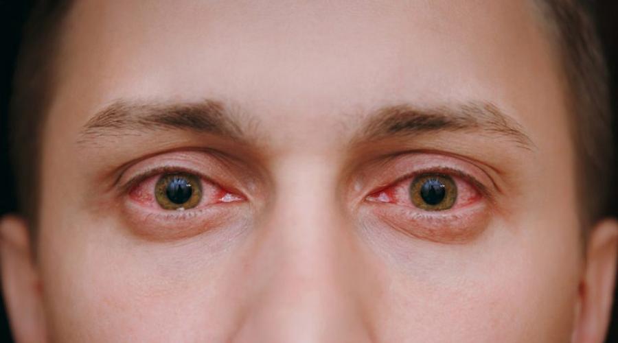 Распространенные инфекции глаз: вирусные, бактериальные, грибковые. Способы лечения вирусного конъюнктивита