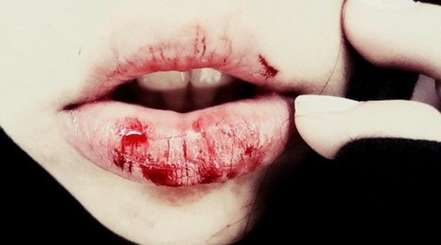 Порезала губу как остановить кровь. Почему губы трескаются и кровоточат и как остановить кровь