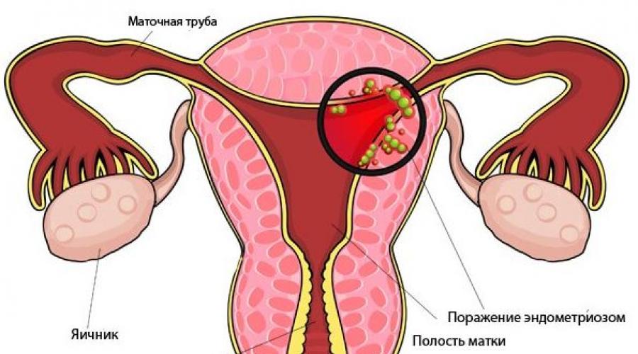 Эндометриоз тела матки — что это такое доступным языком и что нужно знать о данной патологии. Эндометриоз: причины, формы, диагностика, лечение заболевания у взрослых и детей Кистозный эндометриоз
