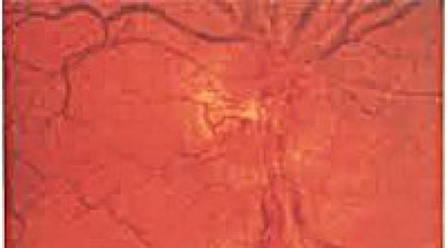  Неврит зрительного нерва: симптомы, причины, что делать, лечение, профилактика. 