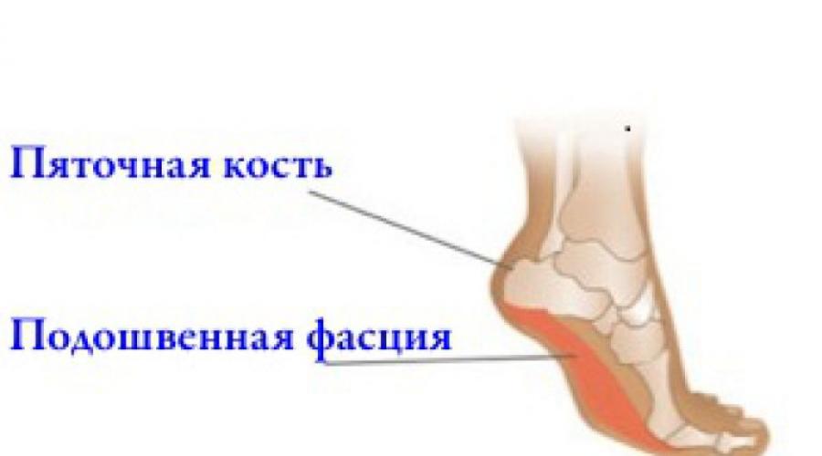 Методы домашнего лечения плантарного фасцита стопы. Фасцит пятки