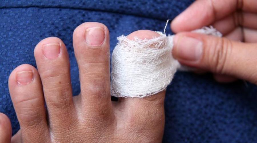 Посинел палец на ноге — причины и лечение. Почему посинел палец на ноге: причины и диагностика