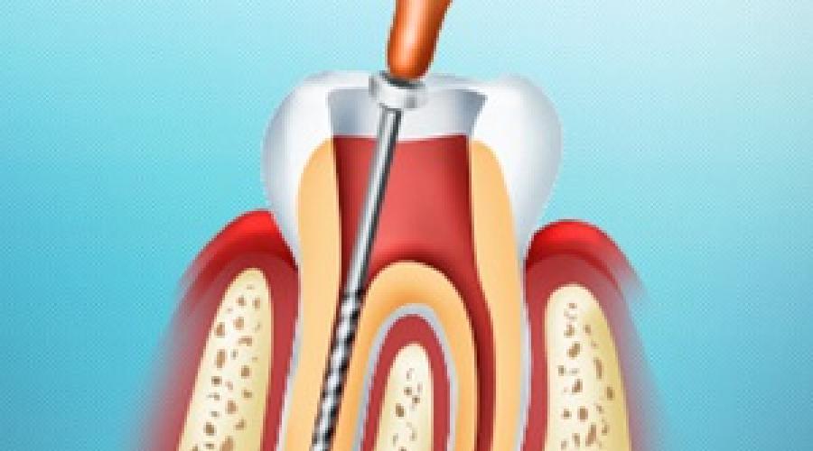 Как происходит процедура удаления нерва из зуба? Основные сложности при удалении зубного нерва и их последствия. 