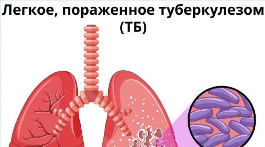 Первые признаки туберкулёза у детей. Как распознать и лечить туберкулез у детей, его виды и профилактика Симптомы туберкулеза у детей 2 лет
