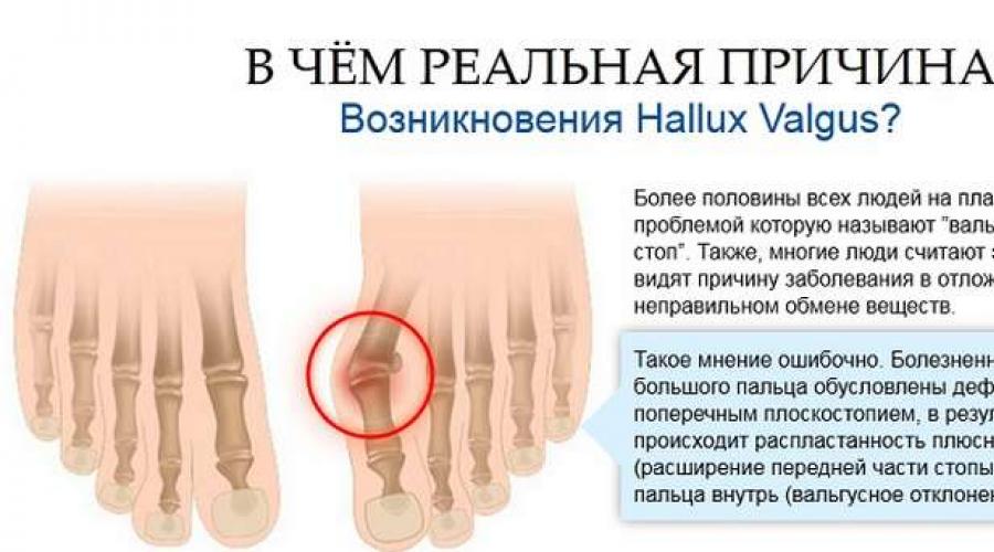 Халлюкс вальгус стопы рентген степени. Поперечный свод стопы. Почему на ступнях выросли кости. Почему наступний растёт кость.