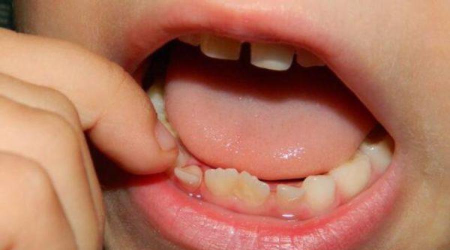  Как отличить коренной зуб от молочного. 