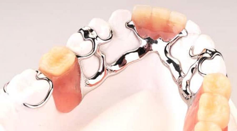 Бюгельное протезирование зубов и его разновидности. Бюгельный протез на замках