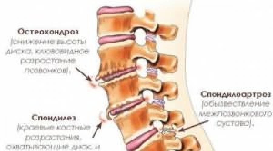Боль в спине или о чем болит позвоночник. Боль в спине и позвоночнике, ее причины и лечение