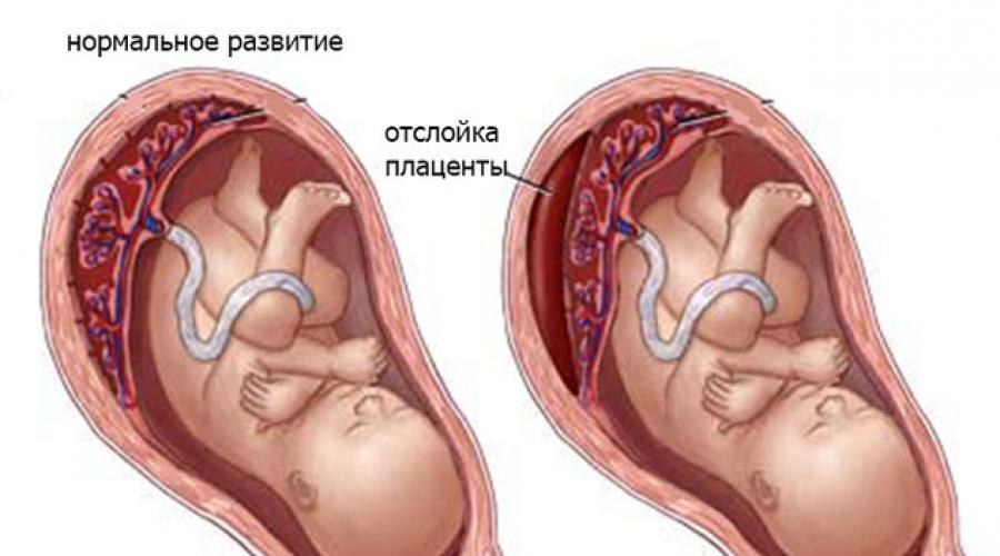 Транексам при наступившей беременности и угрозе выкидыша: цель назначения, инструкция по применению и противопоказания. Транексам - официальная* инструкция по применению
