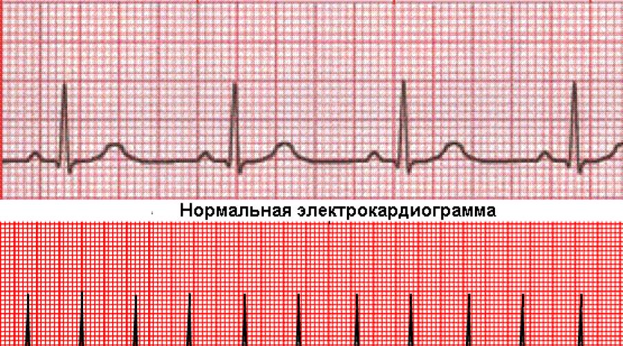 Сильно учащенный пульс. Нормальный сердечный ритм. Нормальное сердцебиение кардиограмма. Пульс на ЭКГ. Нормальный пульс ЭКГ.