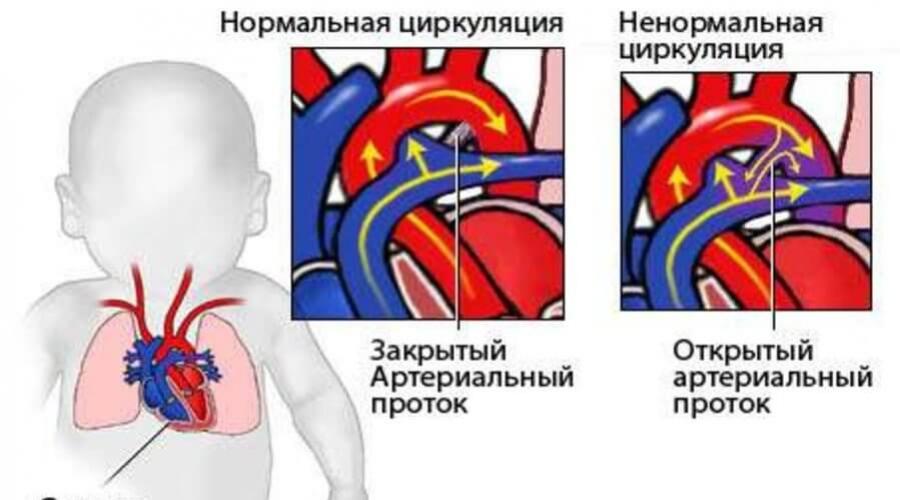 Порок сердца симптомы. Открытый артериальный проток рентген. Открытый артериальный проток у новорожденного. Открытый артериальный проток рентген признаки. Рентген при открытом артериальном протоке.