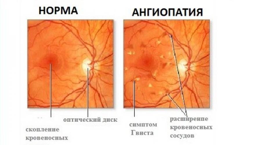 Гипертоническая ангиопатия обоих глаз. Ангиопатия глазного дна. Гипертоническая ретинопатия осложнения. Диабетическая ретинопатия сетчатки глаза. Микроангиопатия сосудов сетчатки.