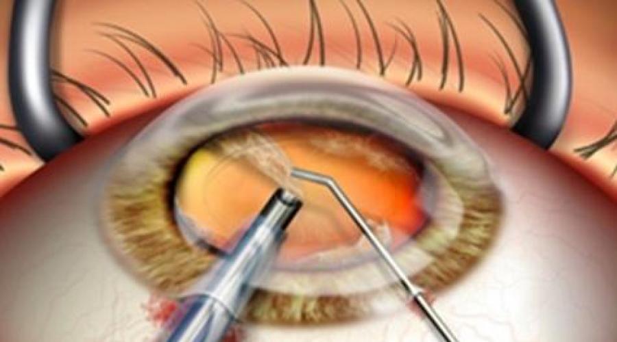 Факоэмульсификация катаракты иол. Факоэмульсификация катаракты