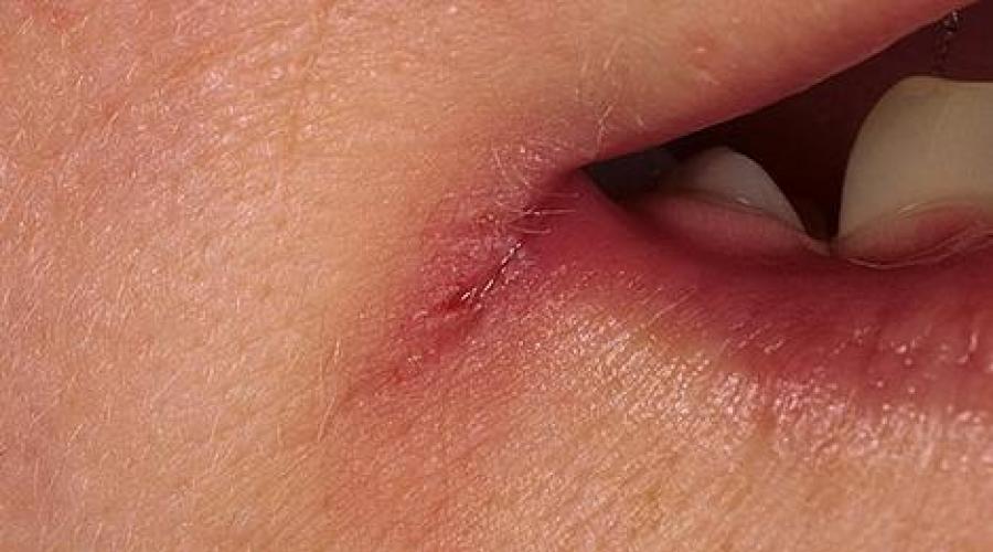 Трещины возле губ причины и лечение. Как ускорить процесс выздоровления? Трещины в уголках рта, причины