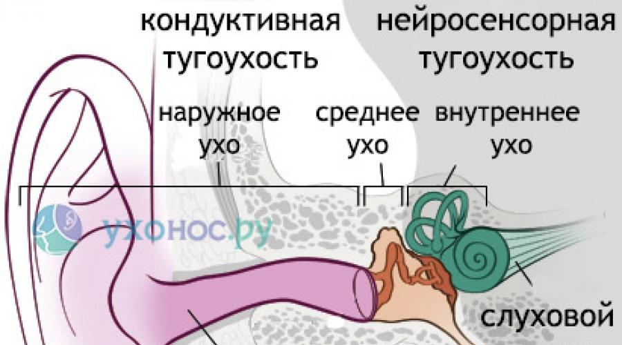 Нейросенсорная тугоухость отзывы