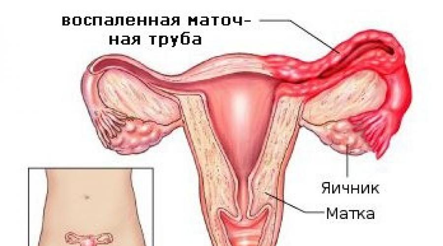 Воспаление матки у женщин симптомы и лечение. Сальпингоофорит (аднексит). Сальпингоофорит симптомы. Подострый сальпингоофорит.