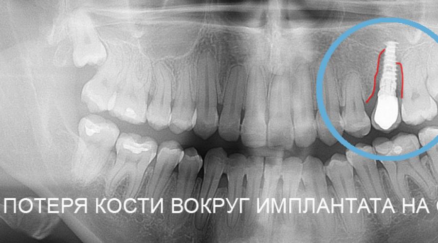 Выпал имплант зуба что делать. Почему отторгаются или не приживаются импланты? Что делать, чтобы избежать выпадение импланта