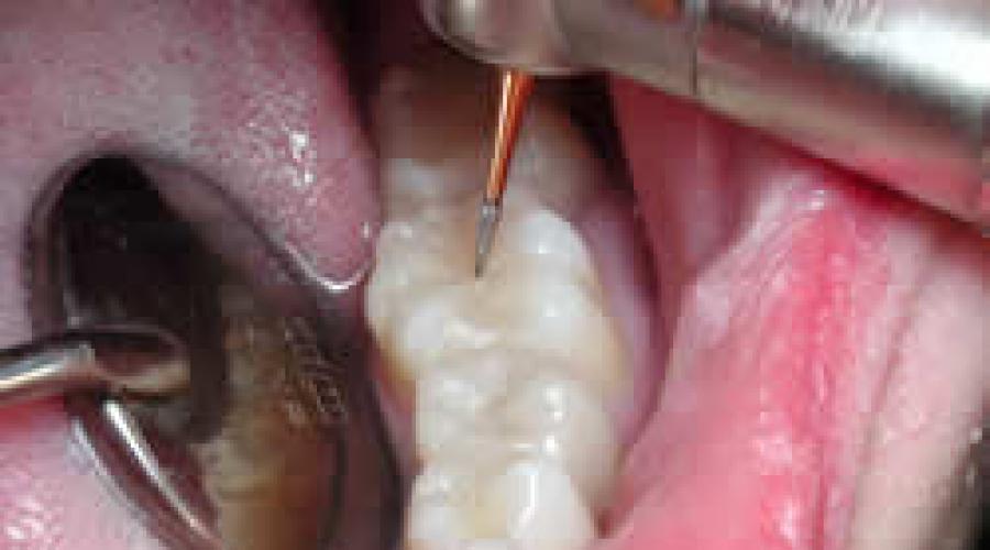 К чему снится выпадение пломбы? К чему снится выпадение пломбы из зуба. 