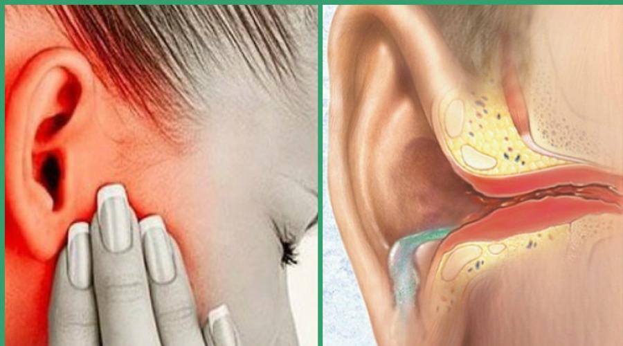 Шум в голове и ушах: причины, лечение, профилактика. Какие таблетки помогают от шума в ушах и голове после гриппа, инсульта, стресса, при ВСД, у пожилых людей? Народные средства от шума в голове и ушах: рецепты