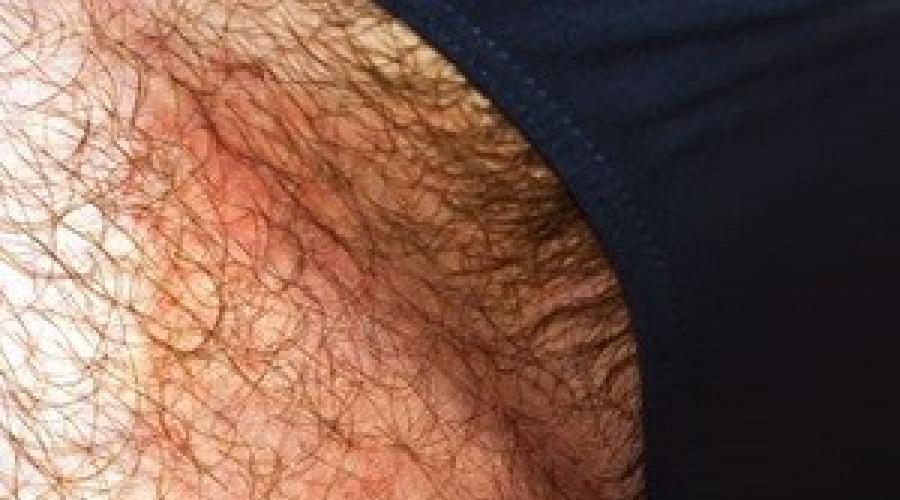 Причины появления красных пятен на коже в интимной зоне у мужчин. Коричневые пятна в паху у мужчин: фото, причины, лечение