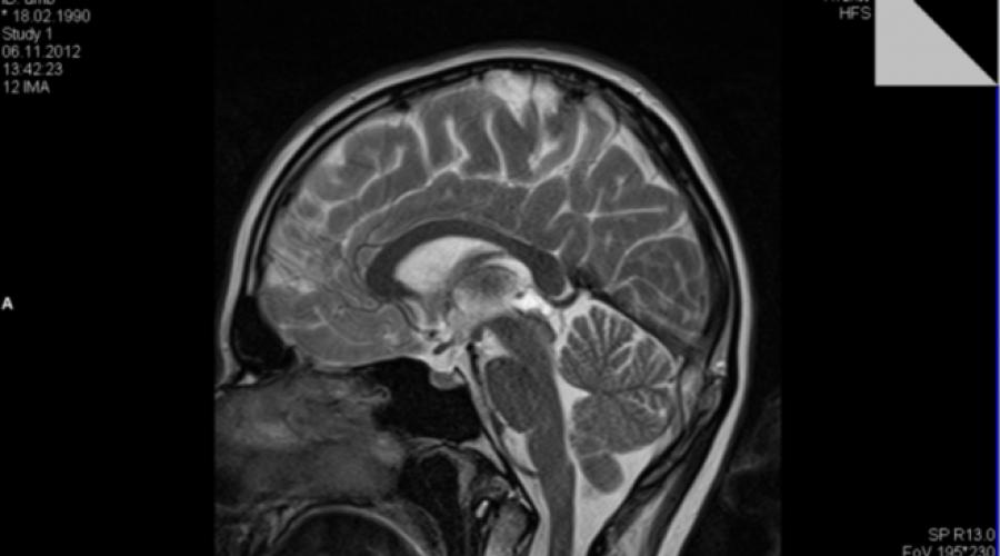 Киста в голове у взрослого последствия лечение. Симптомы и методы лечения кисты головного мозга у взрослого человека